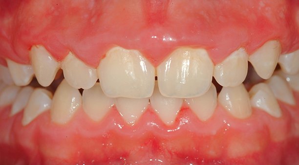 Réduire la plaque sur les dents avec 6 solutions naturelles